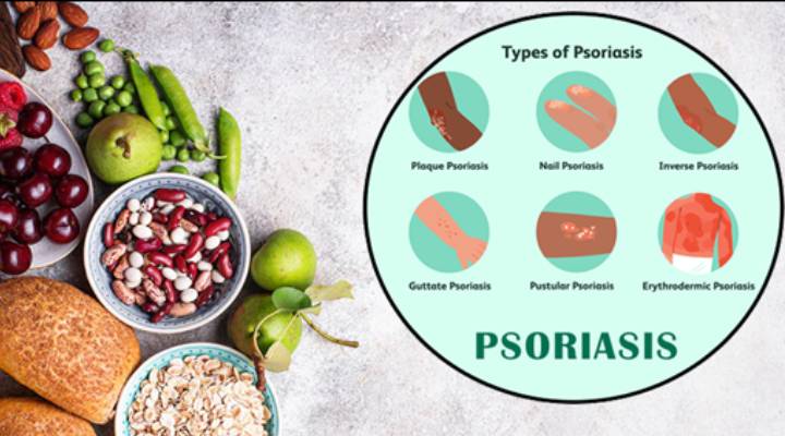 How do I Heal My Psoriasis with Food?